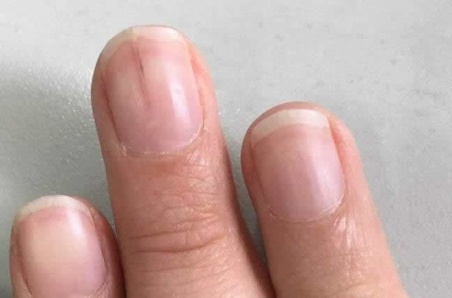 手指竖纹预示身体什么，指甲没有月牙代表什么